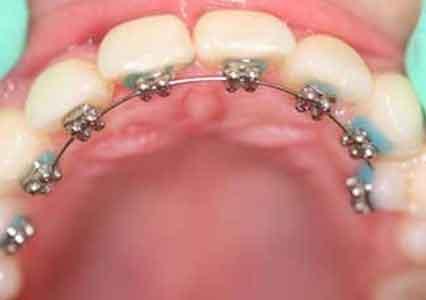 Apparecchio ortodontico fisso linguale